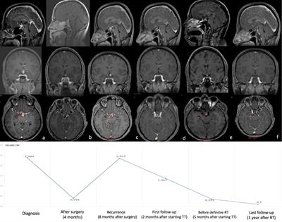 Neoadjuvant B-RAF and MEK Inhibitor Targeted Therapy for Adult Papillary Craniopharyngiomas: A New Treatment Paradigm